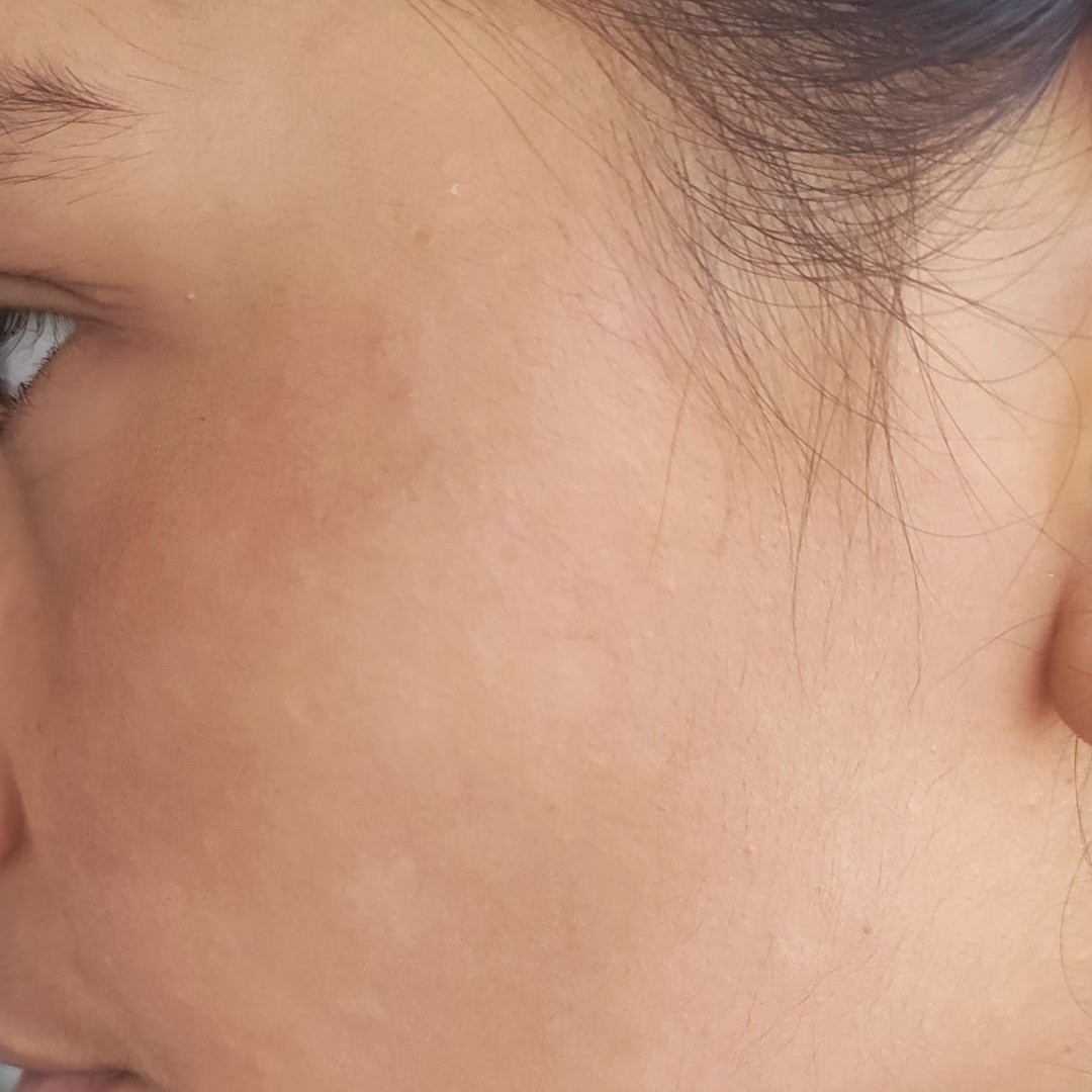 After treatment for acne