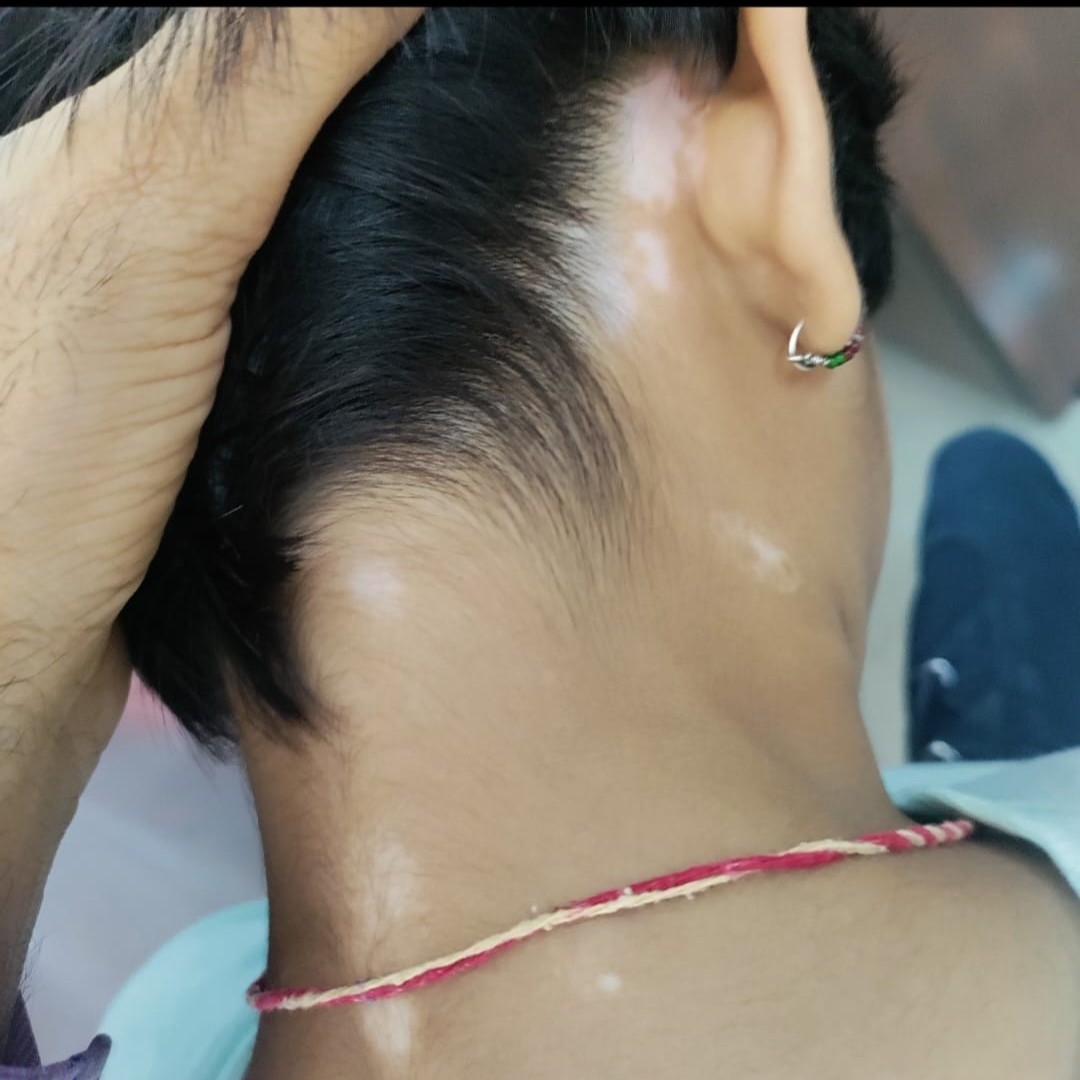 After treatment for vitiligo by Dr. Ashok Meena
