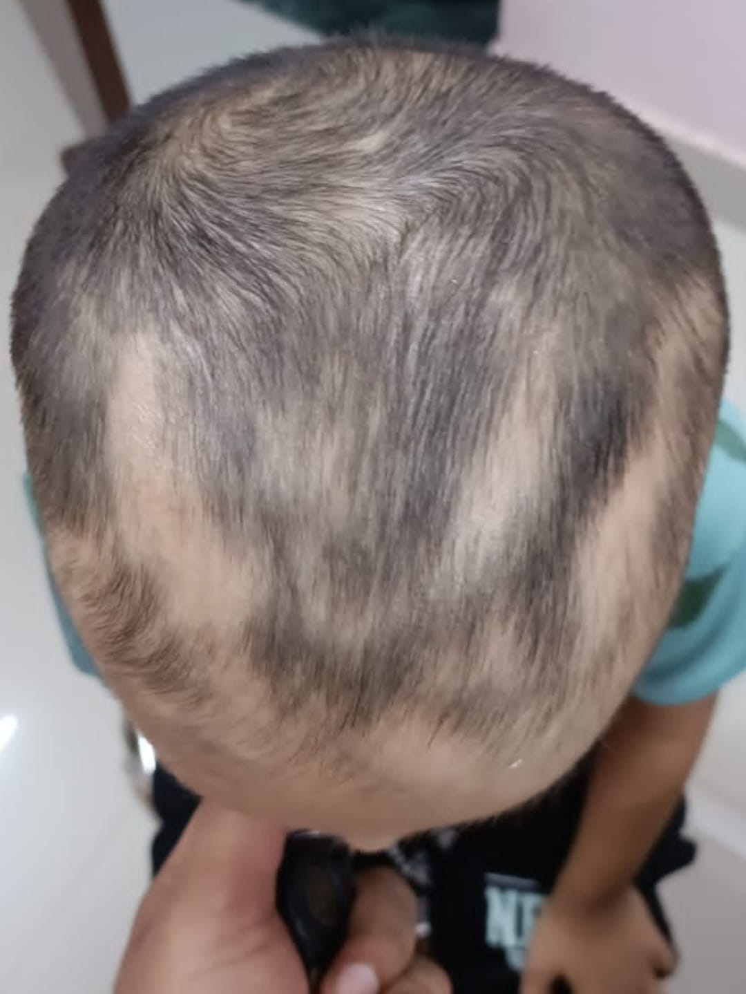 After treatment for alopecia areata