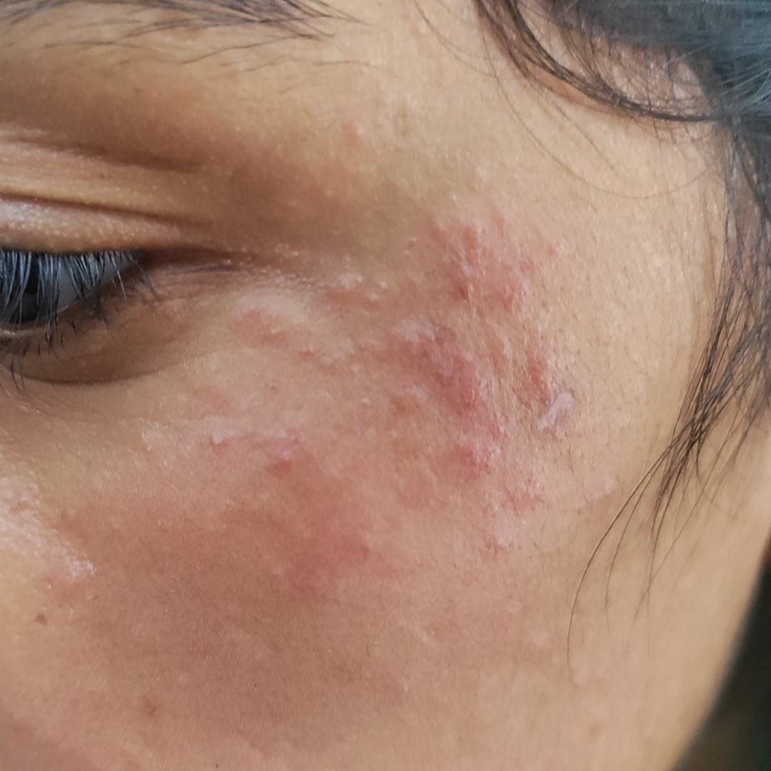 Before treatment for acne